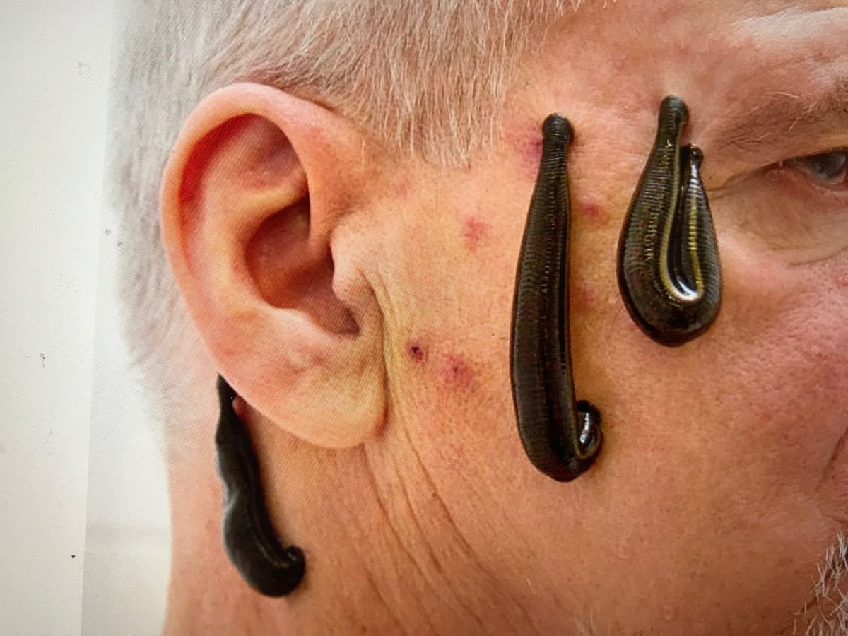 Mơ thấy cố gỡ đỉa ra khỏi người