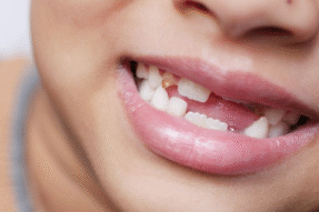 Mơ Thấy Gãy Răng Cửa Và Những Điềm Báo Bất Ngờ